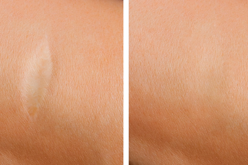 ScarInk Narbenkorrektur Berlin